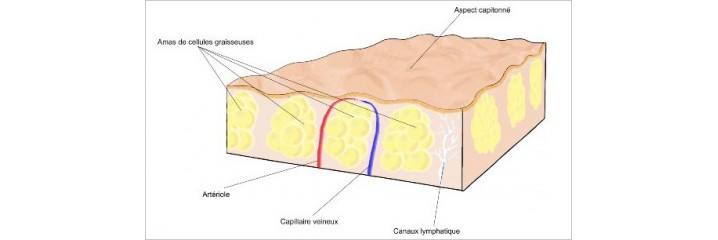 Cellulite		