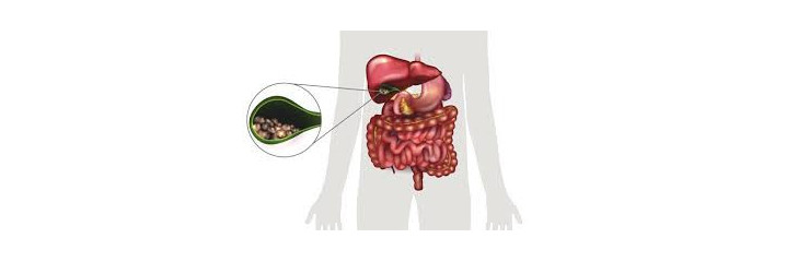 CALCULS BILIAIRES OU LITHIASE BILIAIRE