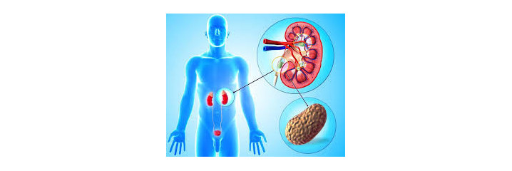 Calculs rénaux, Lithiase rénale - L'Herberie Magasin Bio