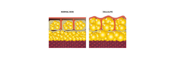 CELLULITE, PEAU D'ORANGE