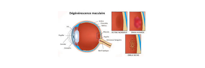 DMLA Dégénérescence masculaire